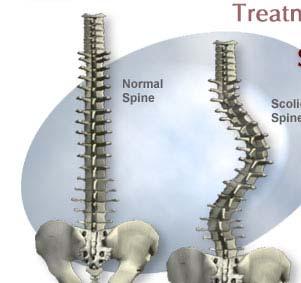 Idiopathic Scoliosis Definitions