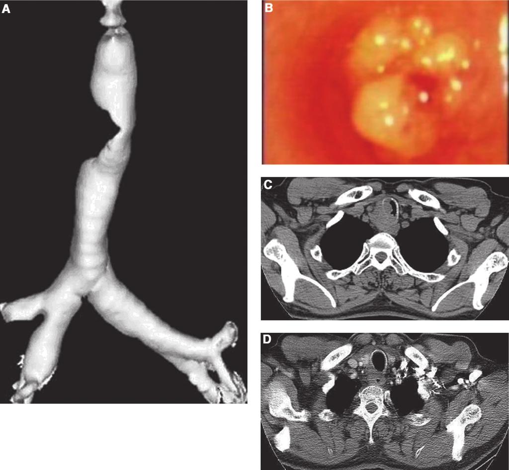 Journal of Thoracic Oncology Volume 1, Number 4, May 2006 Bronchoscopic Intervention in Malignant Obstruction FIGURE 1. Representative case of malignant central airway obstruction.