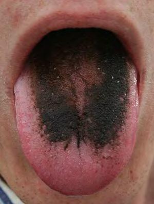 Page 1 of 6 Black hairy tongue From Wikipedia, the free encyclopedia Black hairy tongue A picture of black hairy tongue. Classification and external resources Specialty gastroenterology ICD-10 K14.
