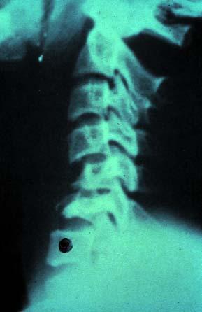 Figure 11.2. Lateral C-spine x-ray of a patient who suffered a facial injury. The black dot marks ver tebra C7. Care must be taken to ensure that all 7 cervical vertebrae are visible.