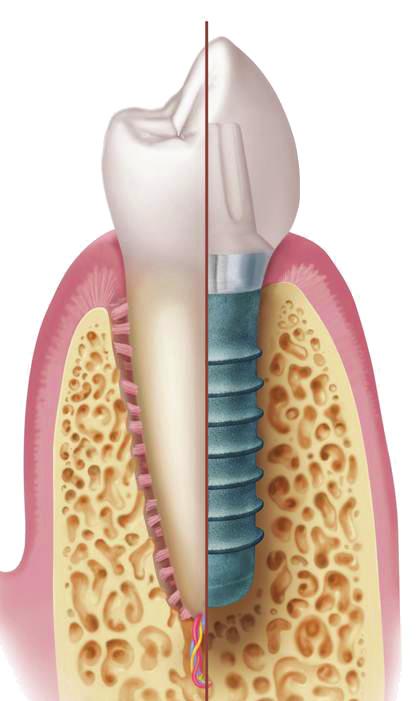 Dental implants are now the standard of care for missing teeth.