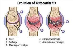 Synvial Jint MUSCULOSKELETAL SYSTEM DISORDER Arthritis is a skeletal disrder resulting frm inflammatin f a jint. There are ver 100 types. Tw mst cmmn: Ostearthritis & Rheumatid Arthritis.