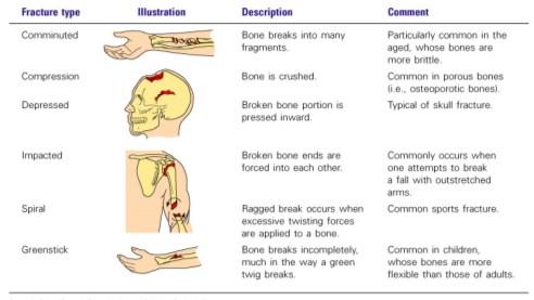 A break in a bone Types of bone fractures Closed (simple) fracture break