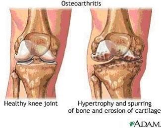 a. Osteoarthritis Most common chronic