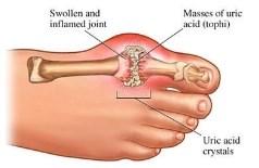 inflammation of certain joints Often