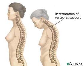 Osteoporosis Bone-thinning disease afflicting 50% women