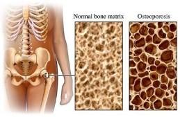 s hump (kyphosis) Femur: broken hip Causes: estrogen