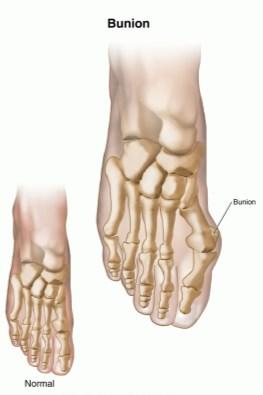 Outward growth between 1 st phalange and metatarsal