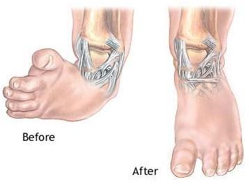 Clubfoot Congenital (at birth) foot deformity