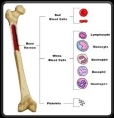 Leukemia cancer of blood cells originating in bone marrow & affects lymphatic