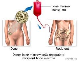 marrow) transplant Youth At birth, the skull bones are incomplete Bones are