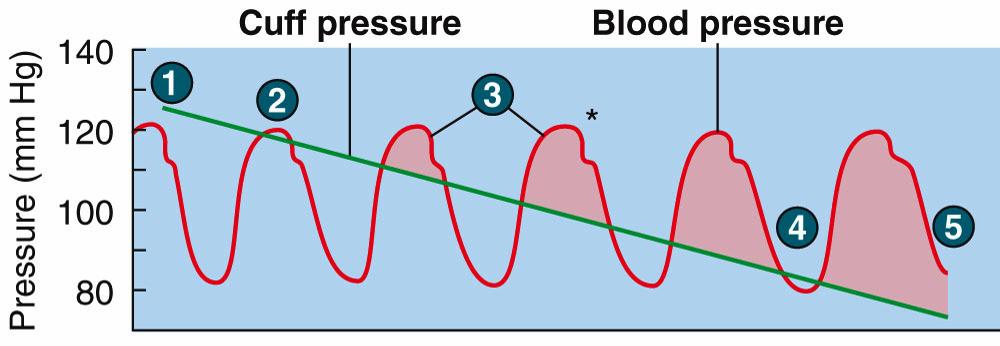 Blood Pressure Auscultation Inflate cuff above Systolic pressure Slowly deflate cuff. Blood flows when BP > Cuff pressure Generates Korotkoff sounds. Clear tapping audible via stethoscope.