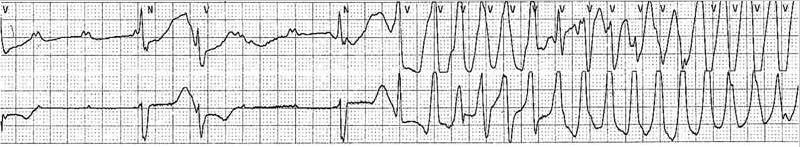 A 70-year-old woman with paroxysmal AF and bifascicular block has frequent episodes of syncope over the past 2