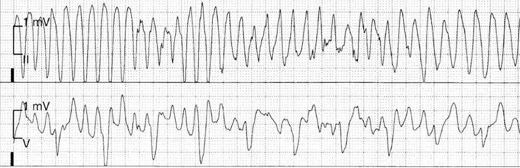 A 75-year-old woman has a past history of anterior MI in 2005. In 2007 she had an aborted cardiac arrest, and a singlechamber ICD was implanted.