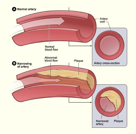 Atherosclerosis A disease in which plaque builds up inside your
