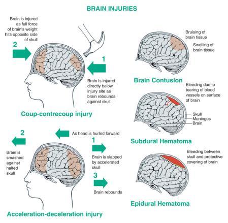 Pathophysiology of Traumatic Brain Injury Contusion Contusion Definitions