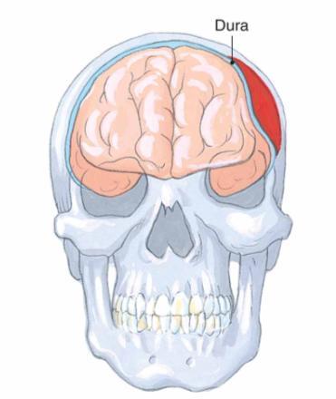 Traumatic Brain Injury Epidural Hematoma