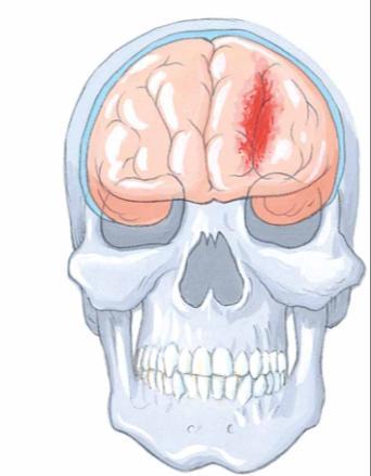Pathophysiology of Traumatic Brain Injury Laceration Laceration