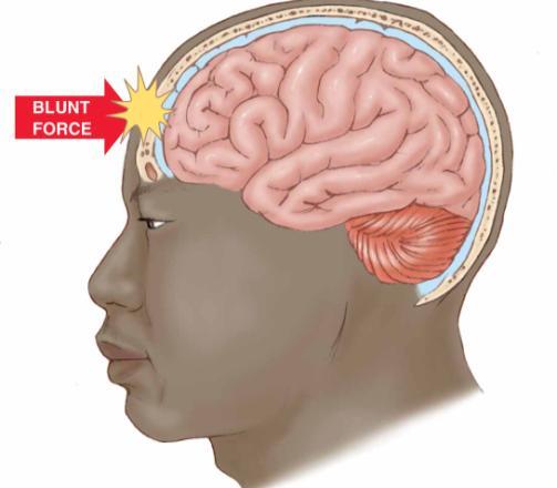 of Traumatic Brain Injury Concussion