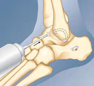 Bio-Tenodesis Screw Fixation in Tendon Enhanced Ankle Ligament Reconstuction Surgical Technique This surgical technique describes an augmented ankle reconstruction using a free tendon graft and rigid