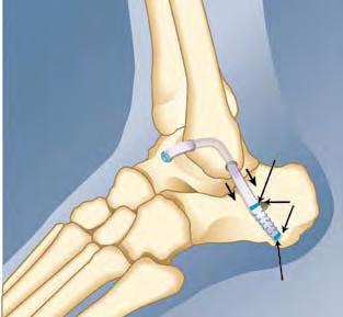 Place sutures into the periosteum on both sides of the ATFL arm of this construct on the posterior fibula.