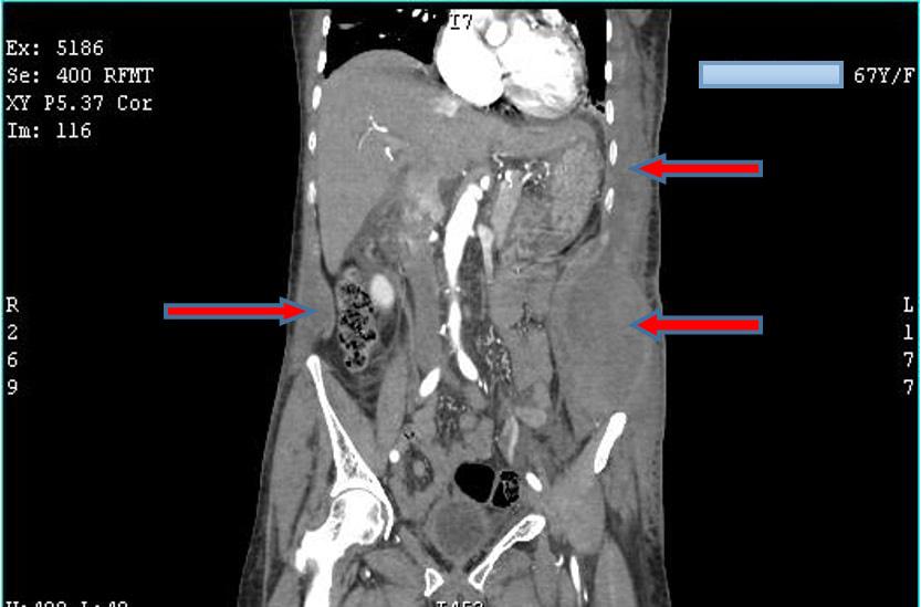 CT showed large hematoma involving the subcutaneous, inter and intra-muscular planes in the postero-lateral aspect of left lower chest wall, extending to antero-lateral abdominal wall and small