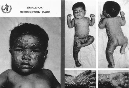 Smallpox disease Incubation Period (Duration: 7 to 17 days) Not contagious Initial Symptoms (Prodrome) (Duration: 2 to 4 days) Sometimes contagious Early Rash (Duration: about 4 days) Most contagious