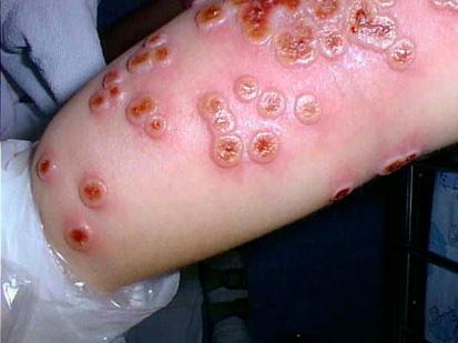 Variola major (smallpox) and