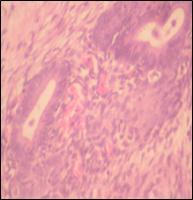 ADJACENT TO IT IS SEEN ENDOMETRIAL GLAND AND STROMA