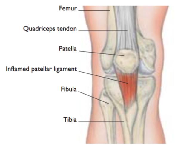 Immediate Treatment RICER. Anti-inflammatory medication. Rehabilitation and Prevention Stretching the quadriceps, hamstrings and calves will help relieve pressure on the patellar tendon.
