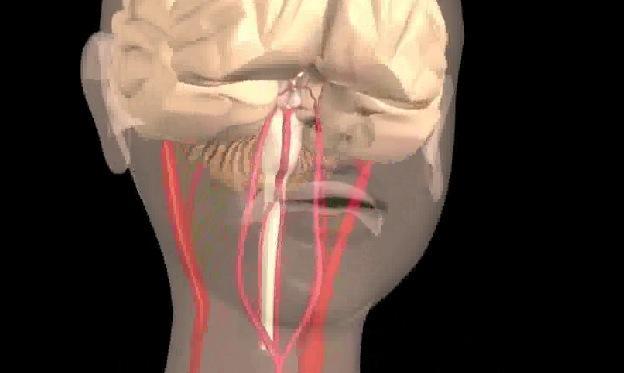 Transient Ischemic Attacks Video Click here to view a video