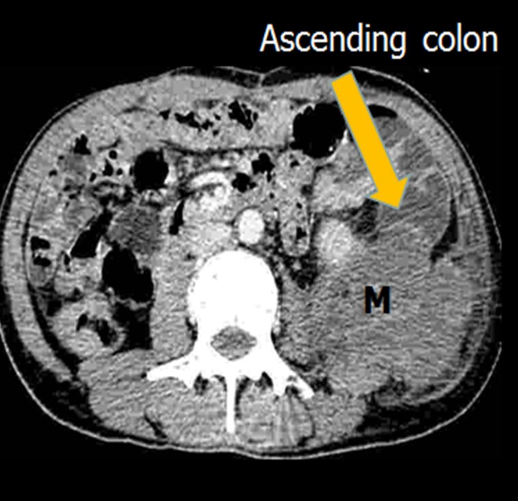 Fig. 8: Thin section axial CT images showing displacement of the