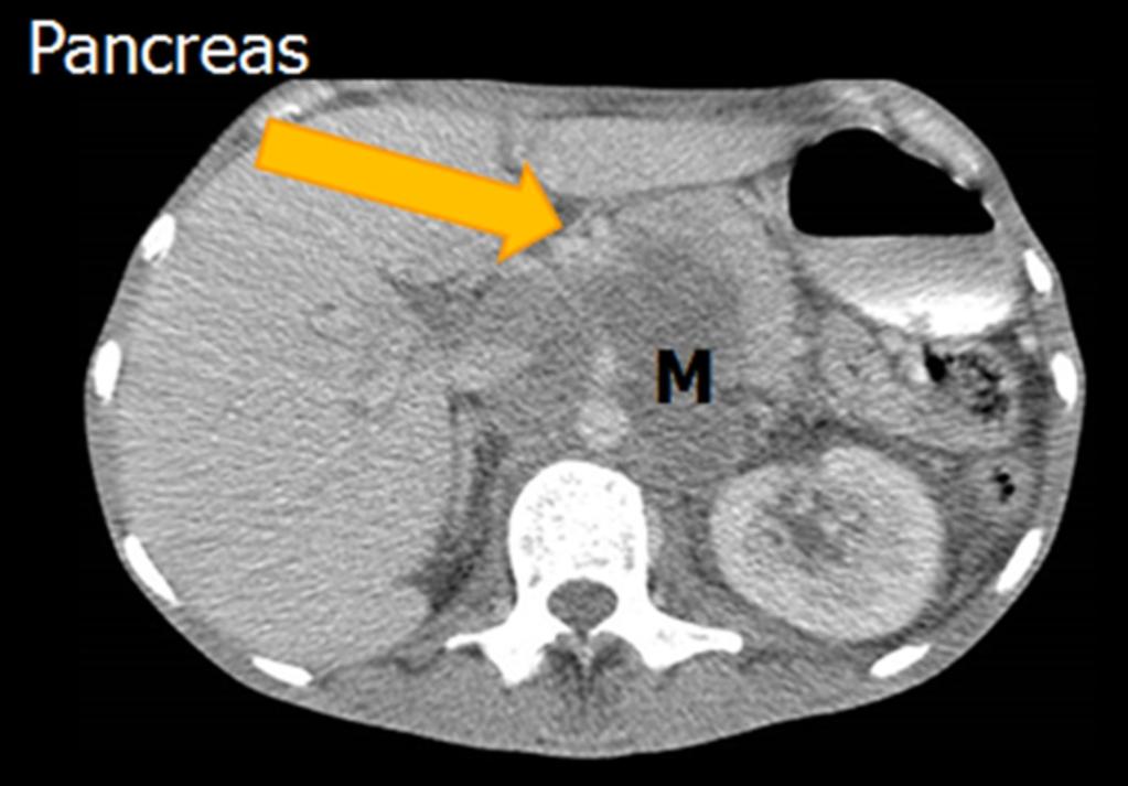 Fig. 9: Axial CECT image showing pancreas