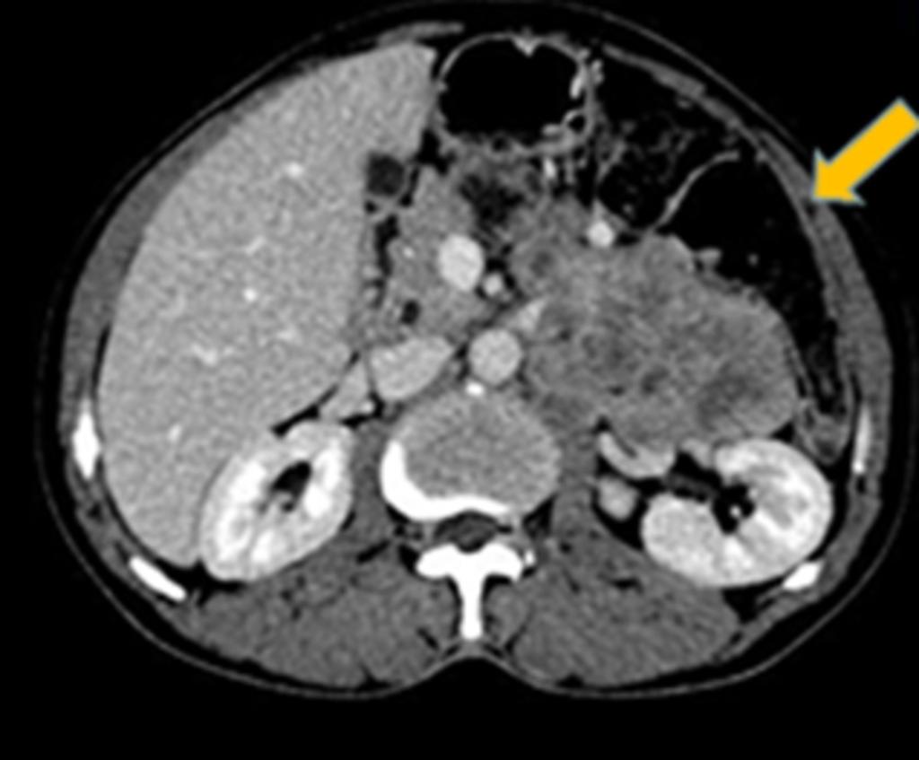 Fig. 10: Axial CECT image showing the pancreatic tail mass