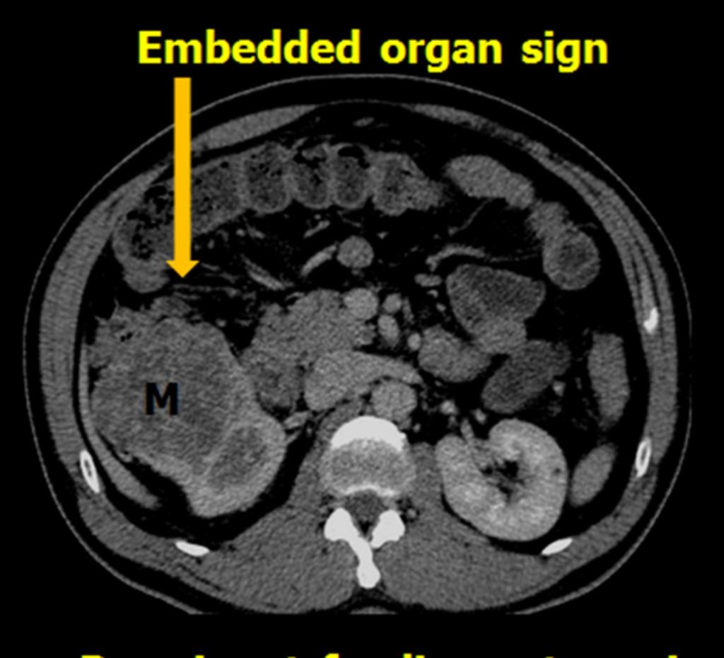 Fig. 22: Axial CECT image of right renal cell carcinoma showing compression of the right kidney by the mass.