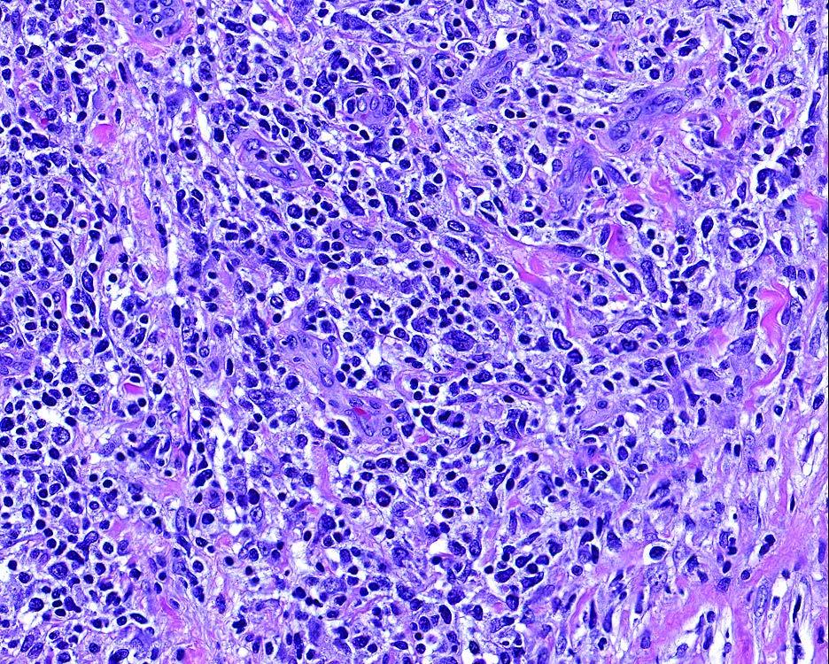 Histologic features Large pleomorphic cells with variably prominent nucleoli