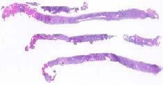 Lymphoma work-up for small biopsies FNA: can be helpful and also submitted for FCM Tiny cores only: submit entire specimen for