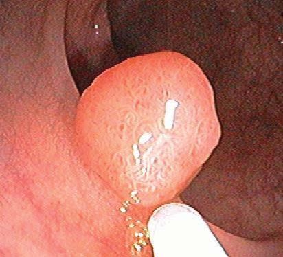 FP - Coats the surface of polyps -