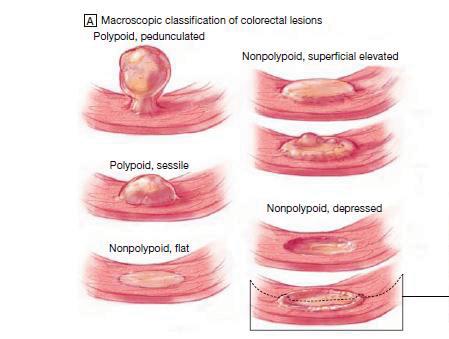 Superficial lesions