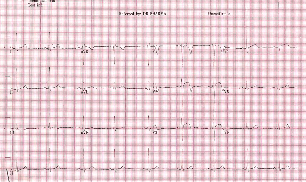 ECG of a 24 Year