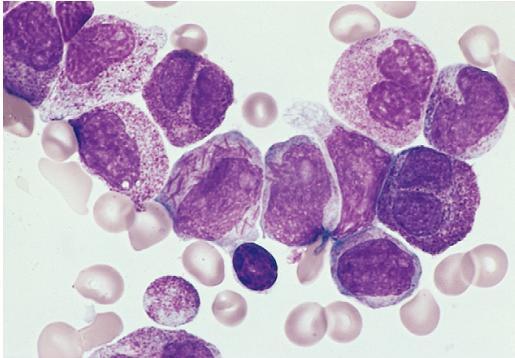 Morphology: AML Granules Bilobed nuclei-cells Needle-like Auer rods (specific for neoplastic myeloblasts) Acute promyelocytic leukemia Bone marrow aspirate: The neoplastic promyelocytes have