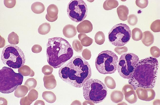 Morphology: CML Chronic myelogenous leukemia peripheral blood smear.