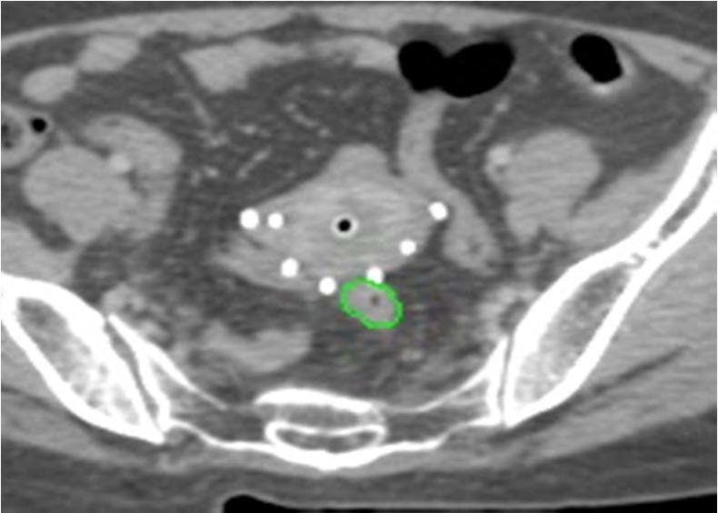 HRCTV Delineation On CT A) Whole Cervix