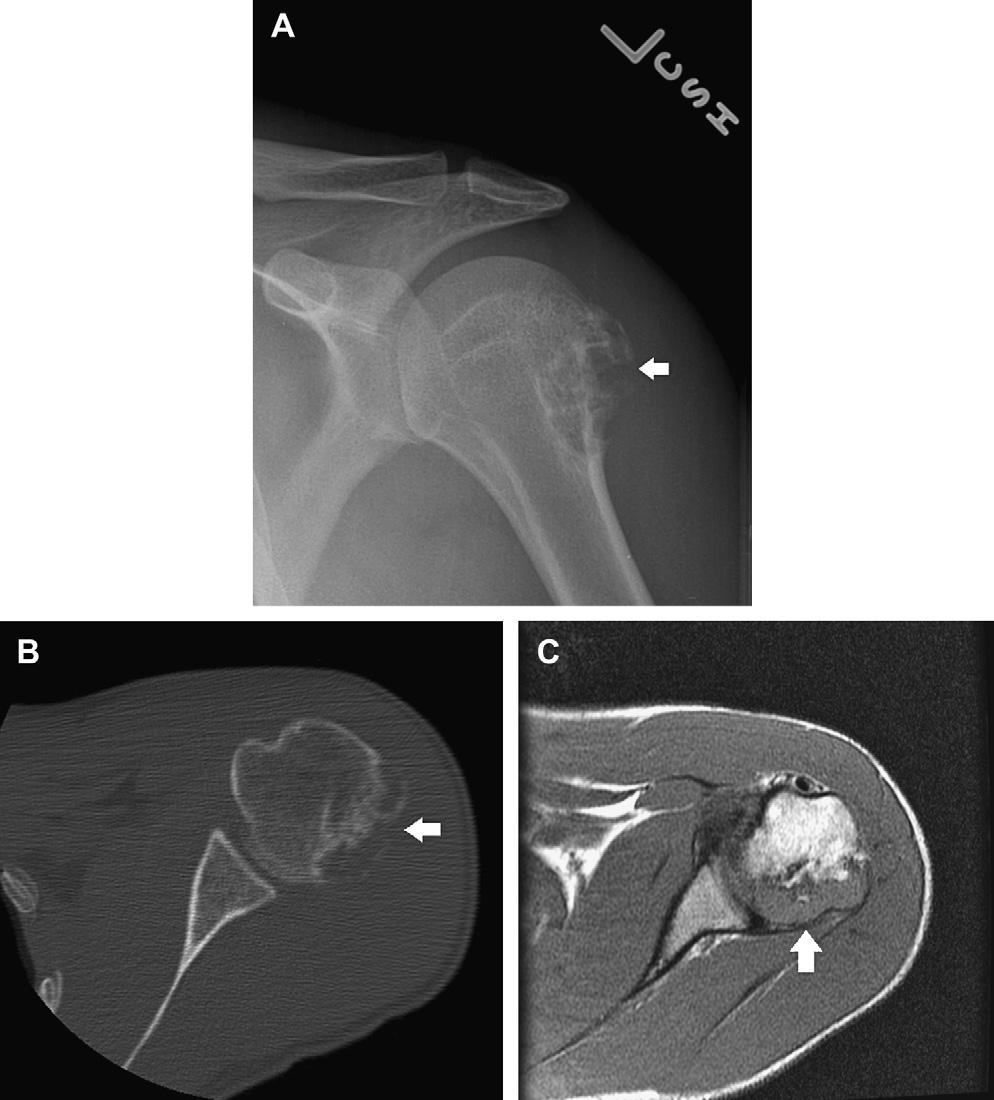 Benign Bone Tumors 1123 Fig. 7. A 21-year-old man with a JC arising from the proximal humerus (arrow).