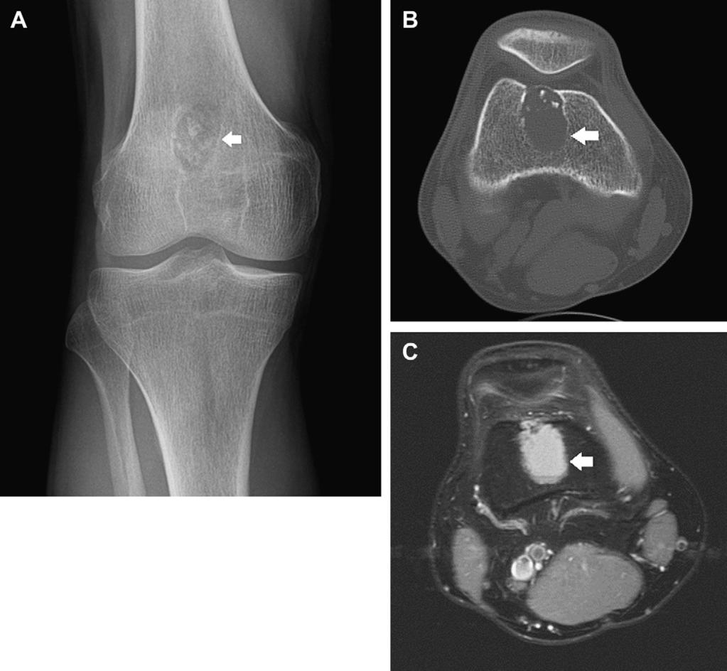Benign Bone Tumors 1125 Fig. 9. A 33-year-old man with a distal femoral chondromyxoid fibroma (arrow).