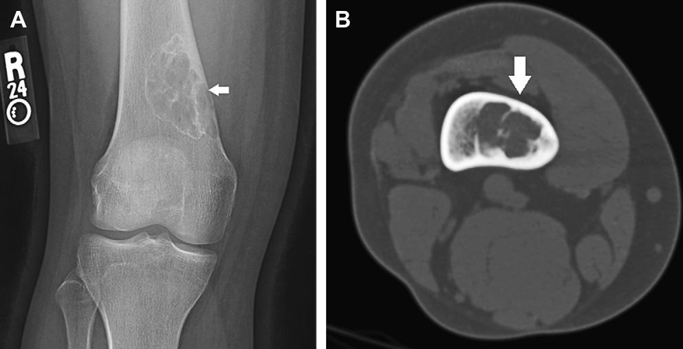 1126 Fig. 10. A 17-year-old boy with a distal femur nonossifying fibroma (arrow). (A) Frontal radiograph shows an eccentric lesion with sclerotic lobulated margins.