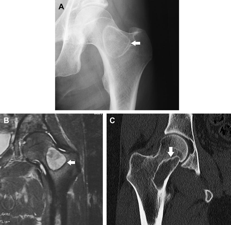 Frontal radiograph (A) shows a lesion with a ground glass appearance and sclerotic margins in the femoral neck.