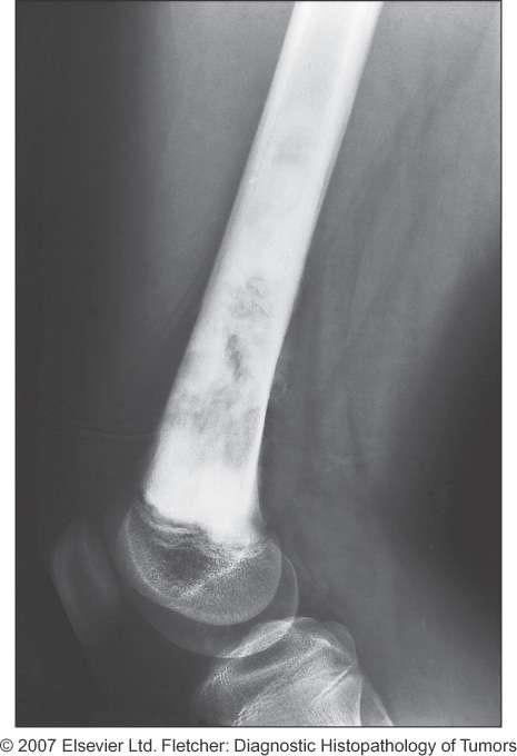 Conventional Osteosarcoma High grade malignant tumour of adolescents and young adults Male predominance