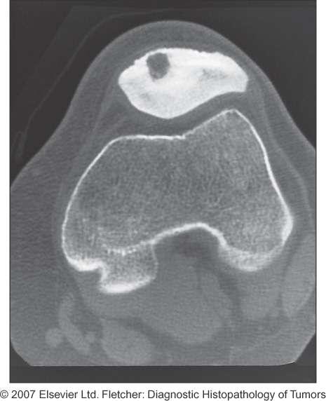 Osteoid osteoma Typical radiological appearance Extremely well circumscribed No permeation Associated