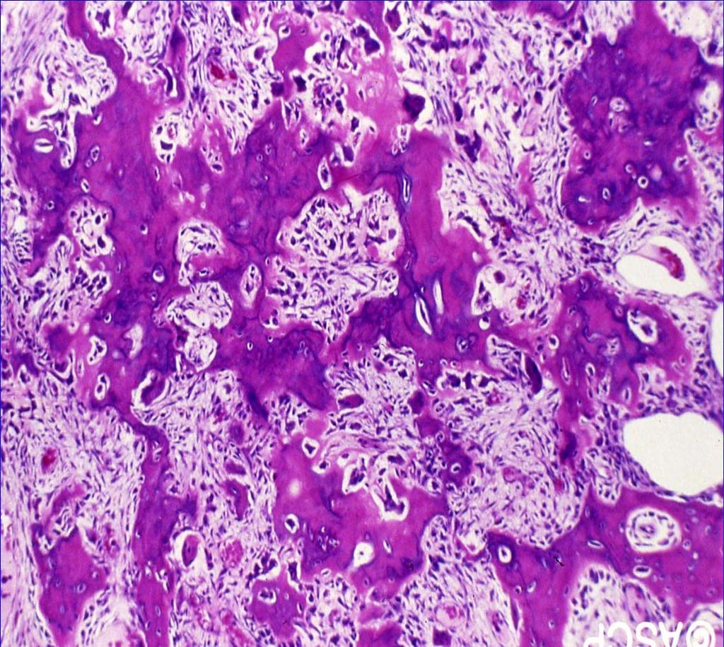 Osteoblastoma Histopathology: Similar to osteoid osteoma although